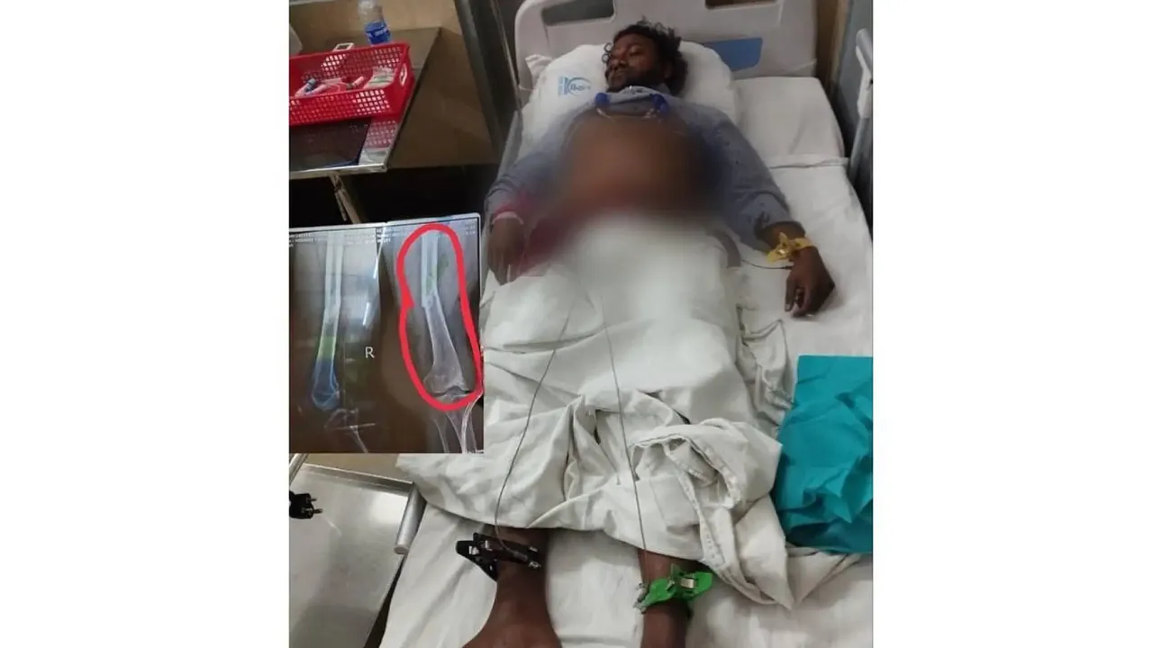 ބަންގްލަދޭޝްގައި ހިނގި އެކްސިޑެންޓެއްގައި ދިވެއްސެއްގެ ފައިބިނދިއްޖެ!