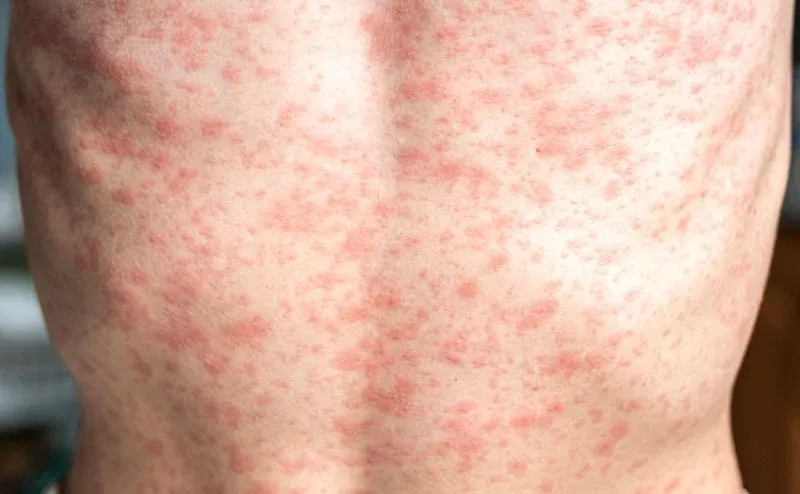 Characteristic rash caused by measles which appears 3-5 days after fever (Photo/EmergencyPhysicians.org)